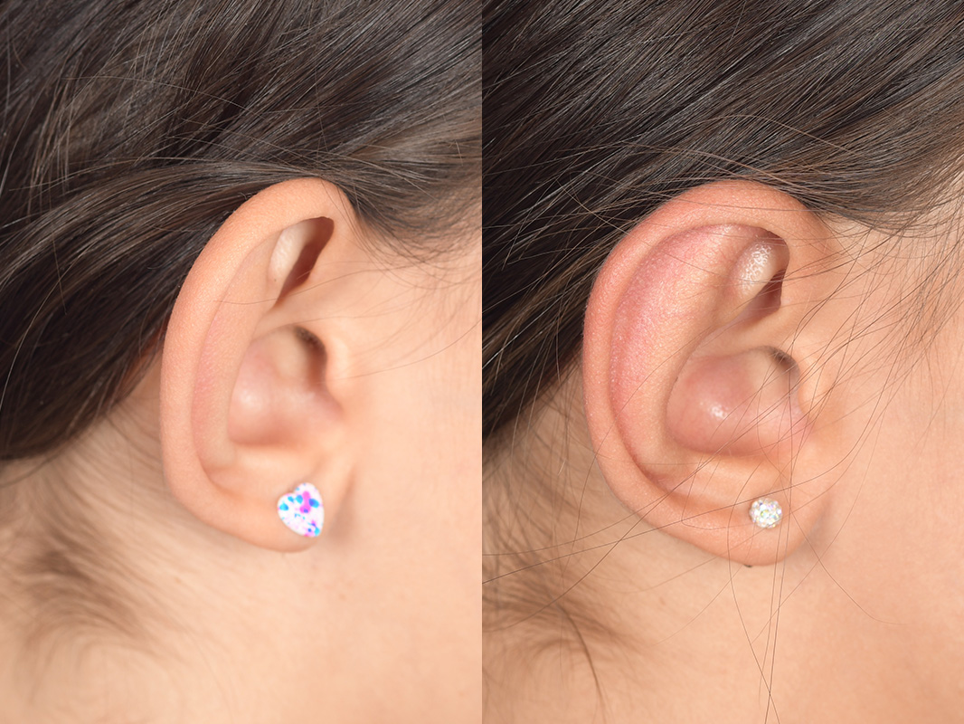 Otoplasty Before and After | Weber Facial Plastic Surgery