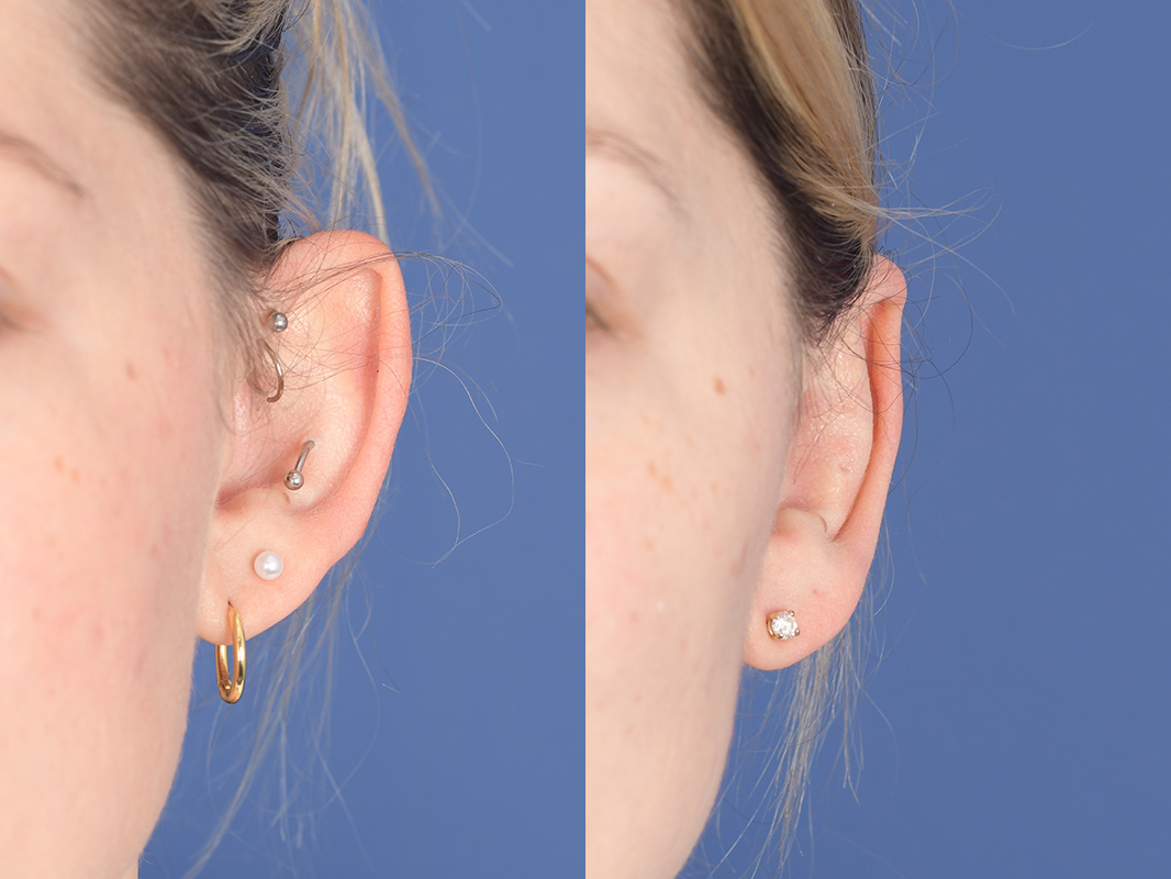 Otoplasty Before and After | Weber Facial Plastic Surgery