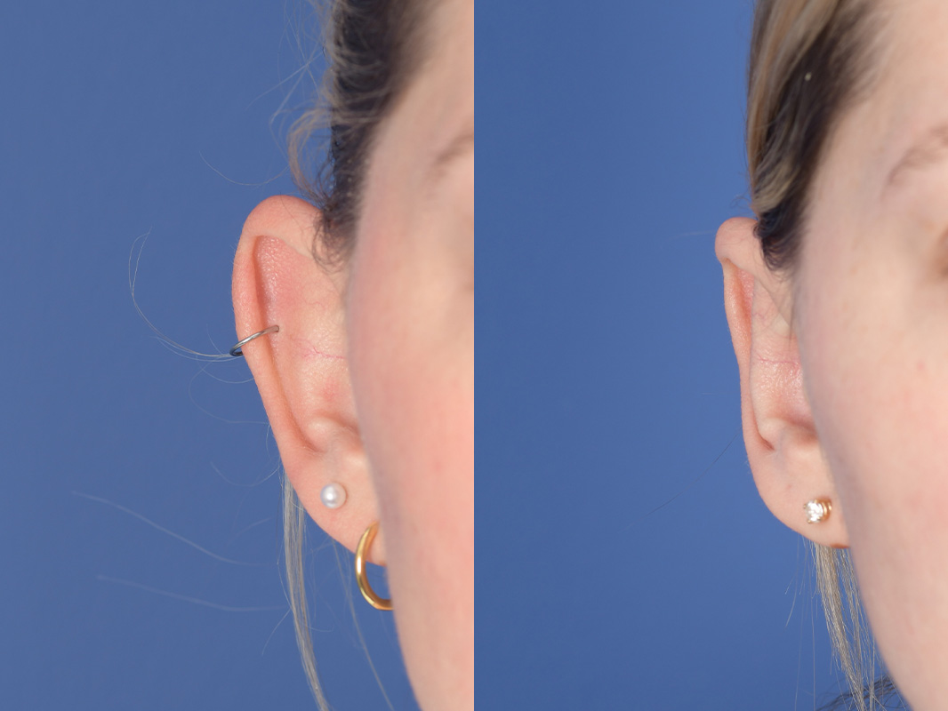 Otoplasty Before and After | Weber Facial Plastic Surgery