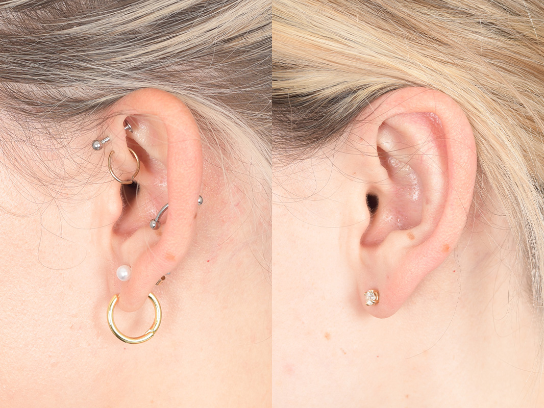 Otoplasty Before and After | Weber Facial Plastic Surgery