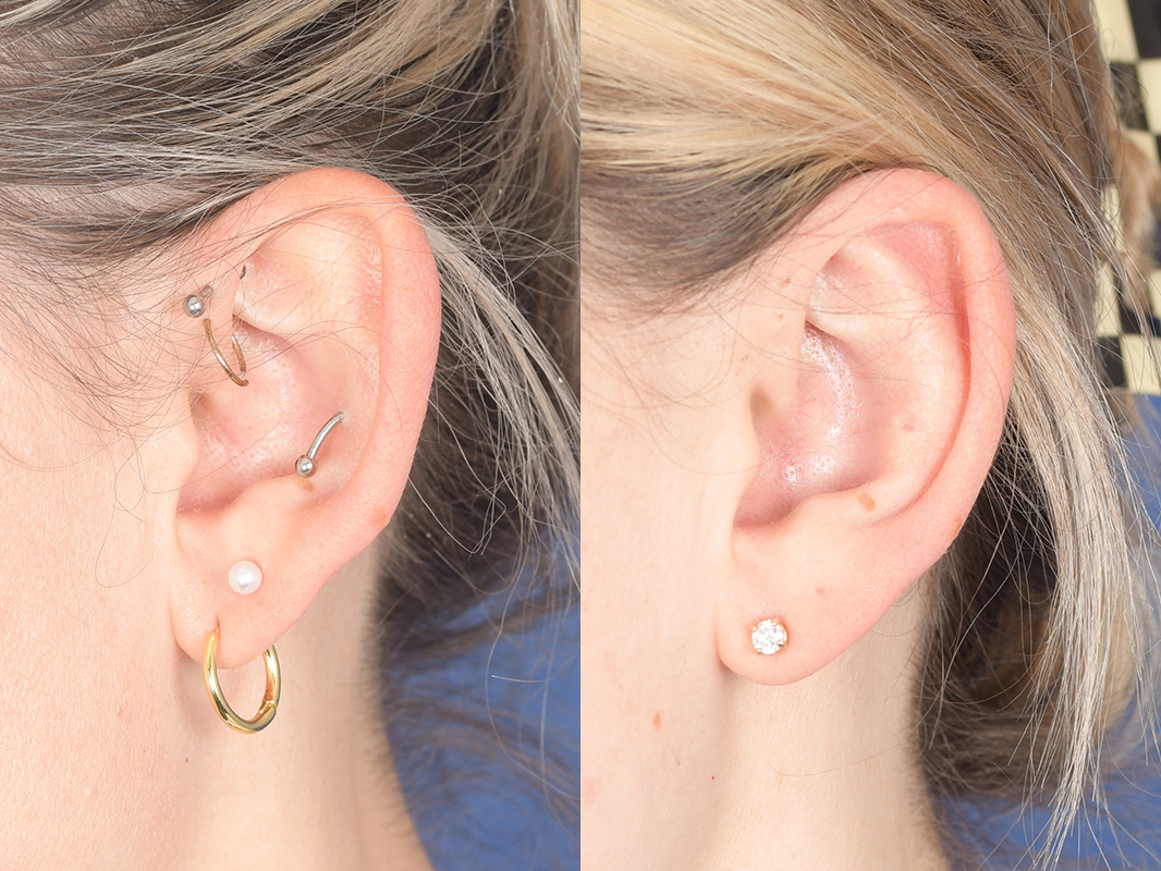 Otoplasty Before and After | Weber Facial Plastic Surgery