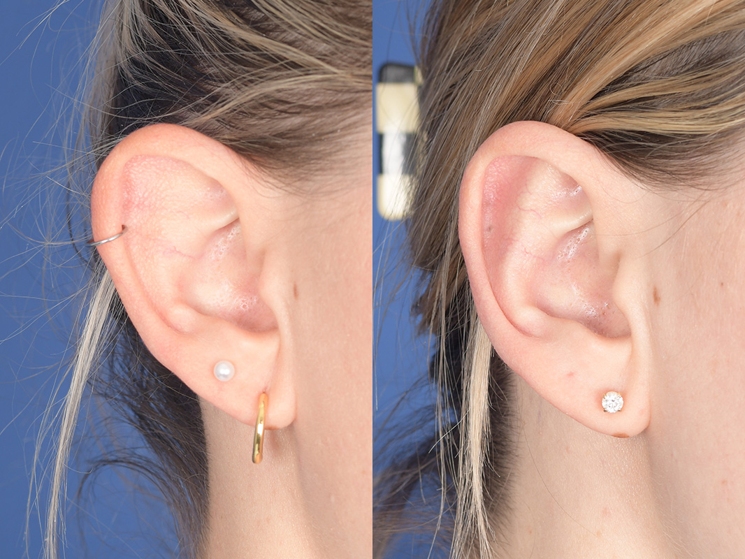 Otoplasty Before and After | Weber Facial Plastic Surgery