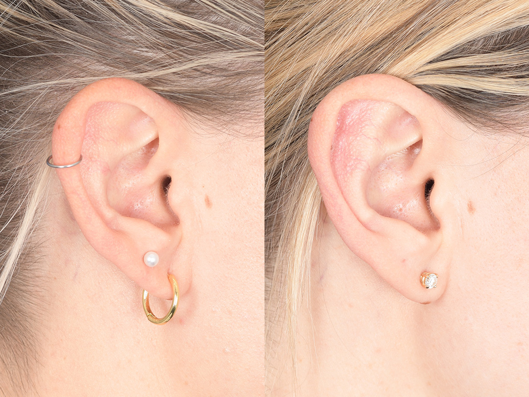 Otoplasty Before and After | Weber Facial Plastic Surgery