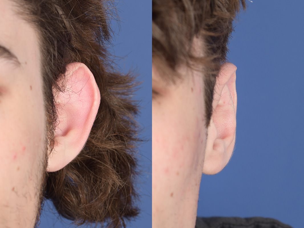 Otoplasty Before and After | Weber Facial Plastic Surgery