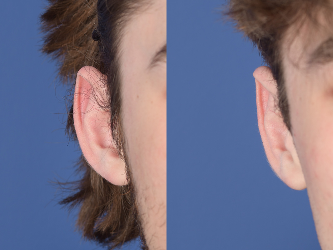 Otoplasty Before and After | Weber Facial Plastic Surgery