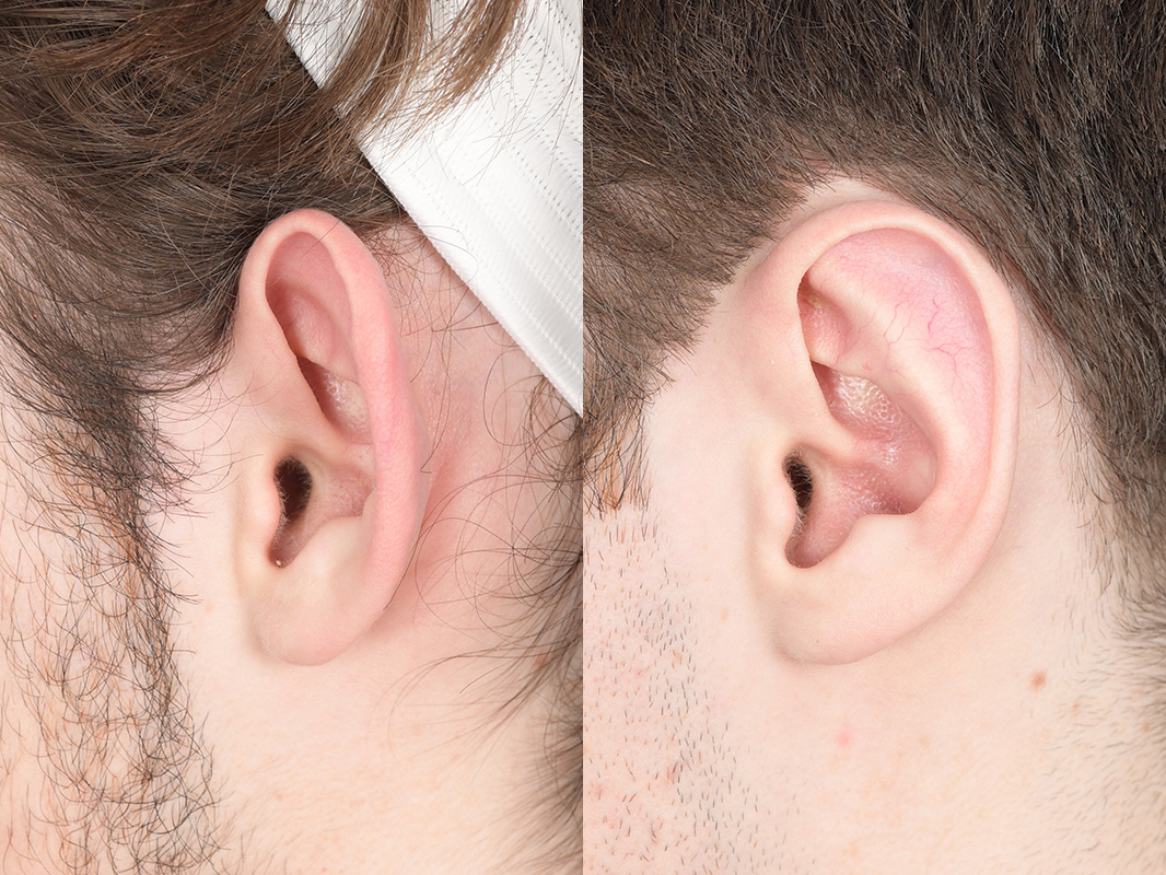 Otoplasty Before and After | Weber Facial Plastic Surgery