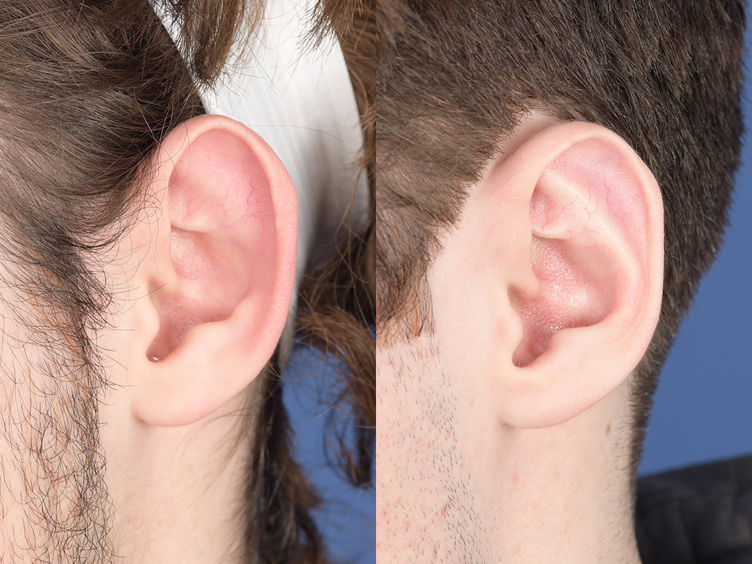 Otoplasty Before and After | Weber Facial Plastic Surgery