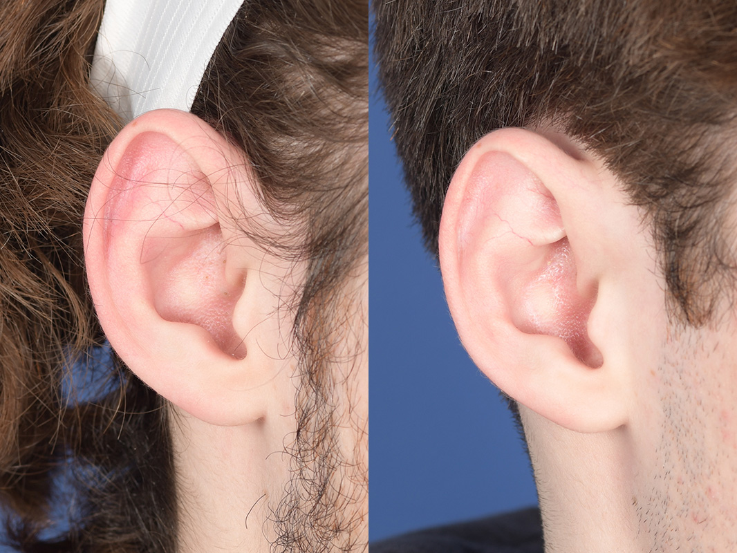Otoplasty Before and After | Weber Facial Plastic Surgery