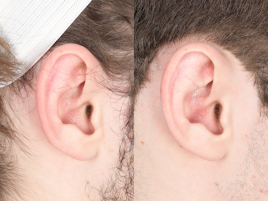 Otoplasty Before and After | Weber Facial Plastic Surgery