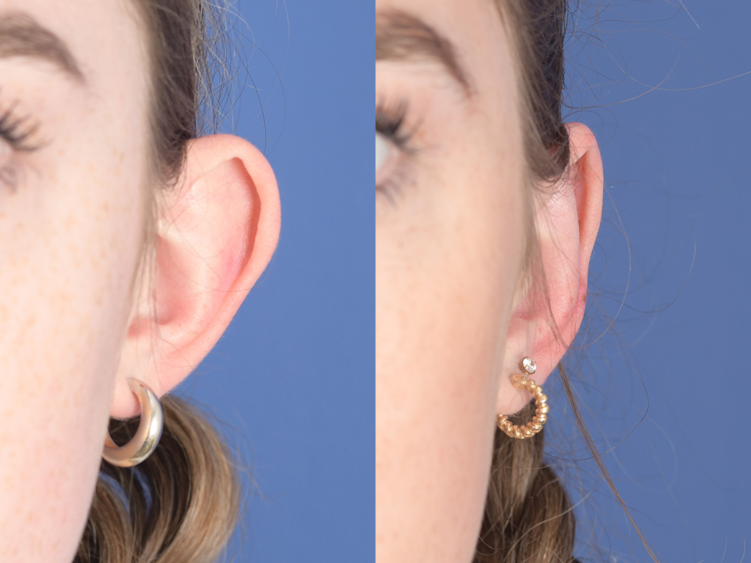 Otoplasty Before and After | Weber Facial Plastic Surgery