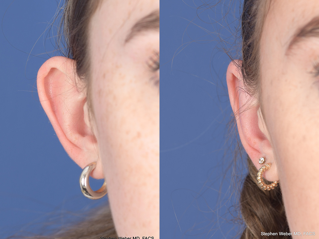 Otoplasty Before and After | Weber Facial Plastic Surgery