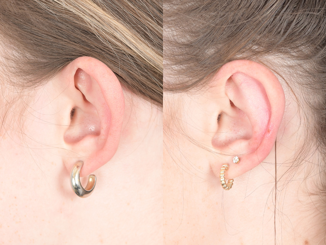 Otoplasty Before and After | Weber Facial Plastic Surgery