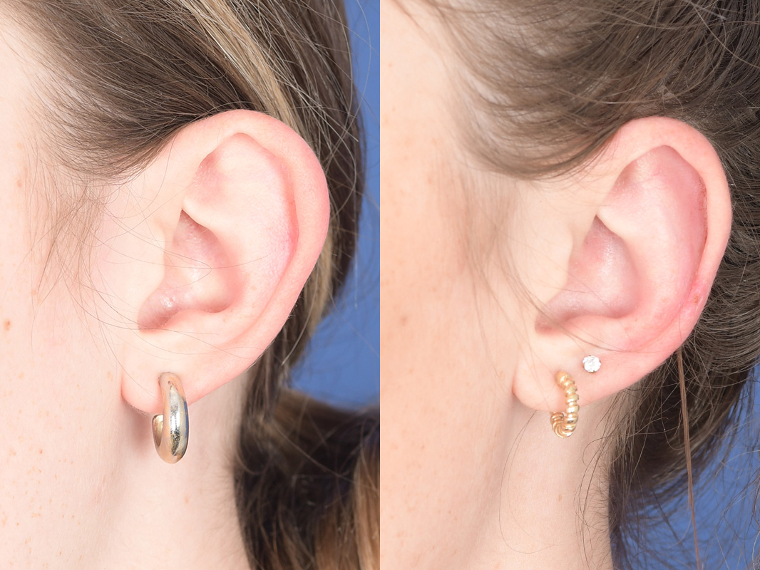 Otoplasty Before and After | Weber Facial Plastic Surgery
