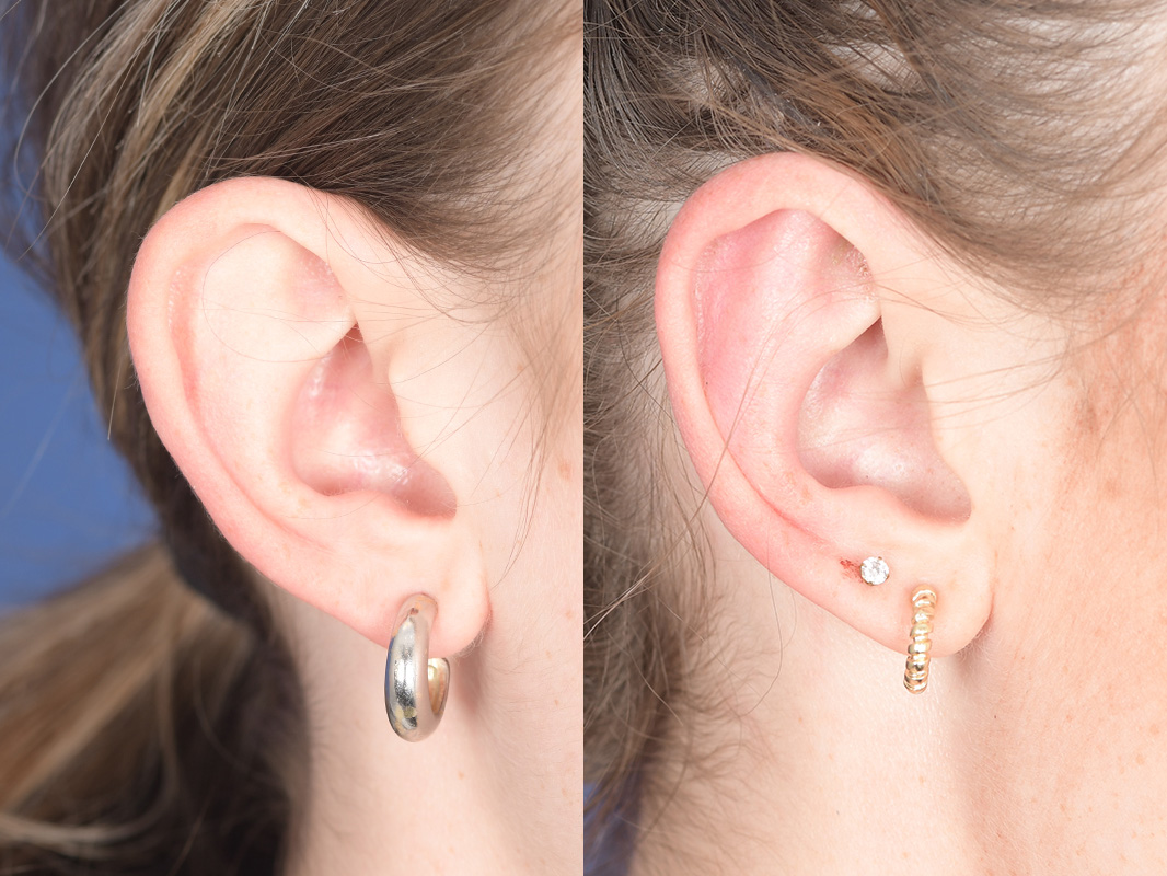 Otoplasty Before and After | Weber Facial Plastic Surgery