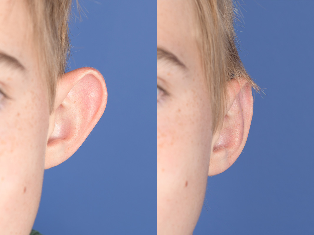 Otoplasty Before and After | Weber Facial Plastic Surgery