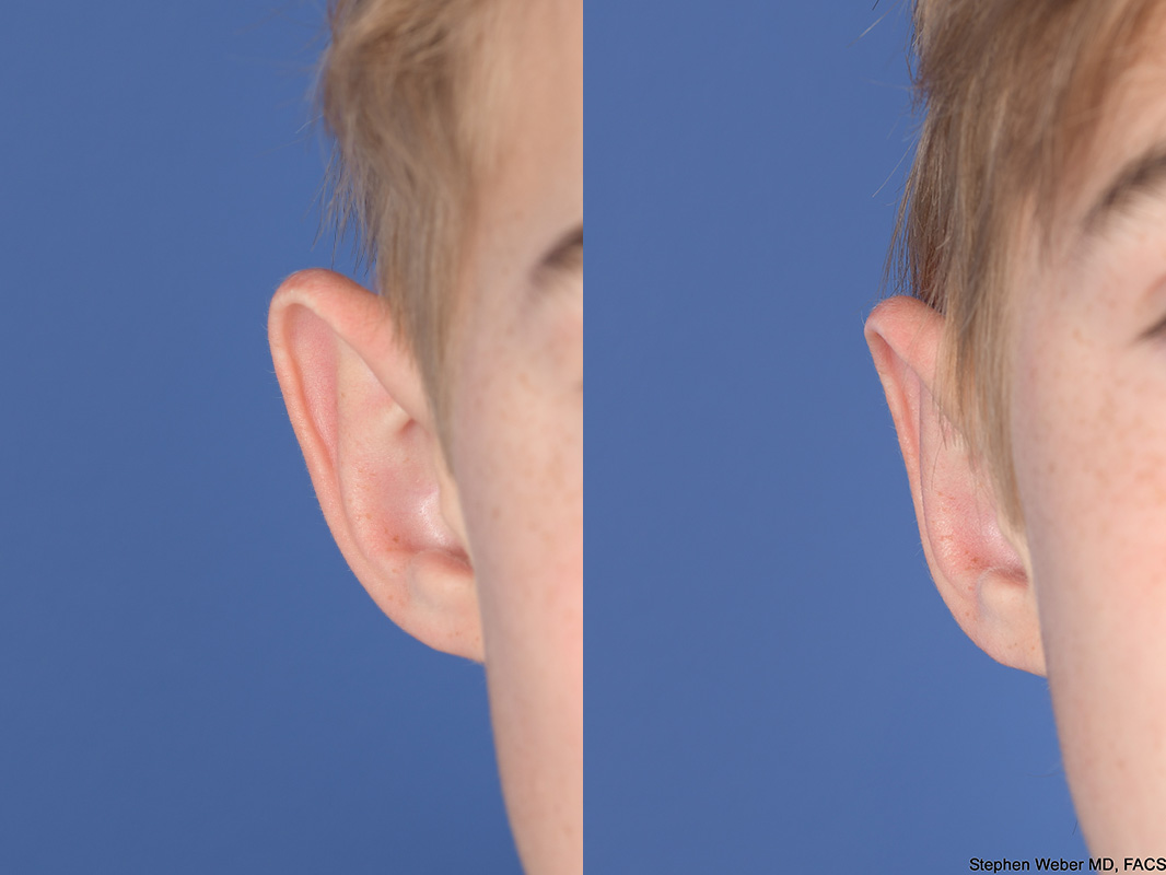 Otoplasty Before and After | Weber Facial Plastic Surgery