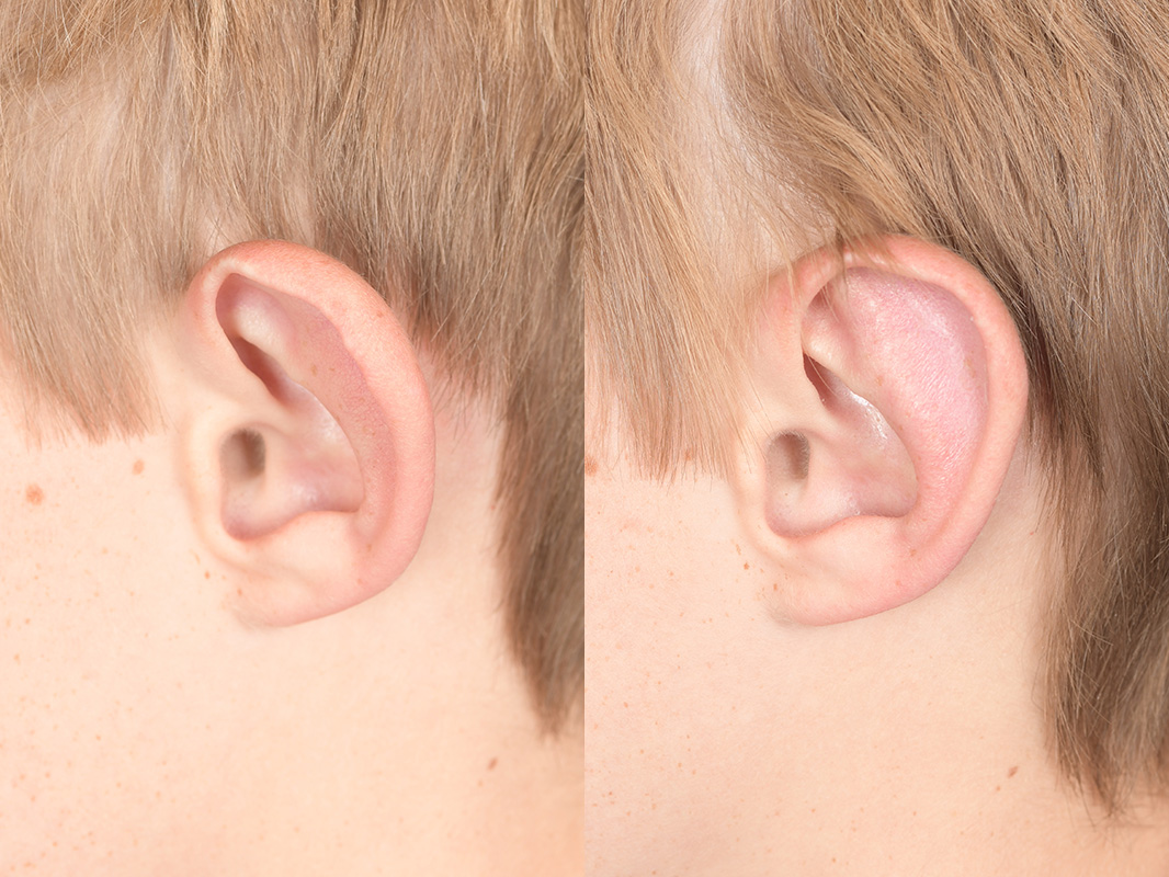 Otoplasty Before and After | Weber Facial Plastic Surgery