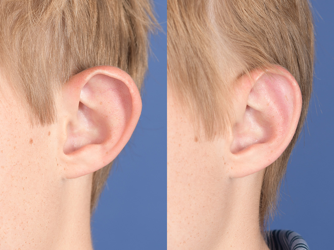 Otoplasty Before and After | Weber Facial Plastic Surgery