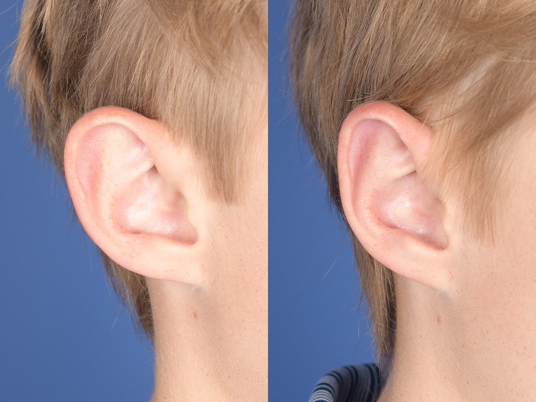 Otoplasty Before and After | Weber Facial Plastic Surgery