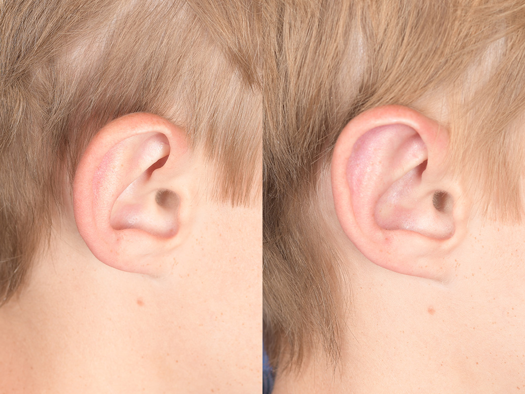 Otoplasty Before and After | Weber Facial Plastic Surgery