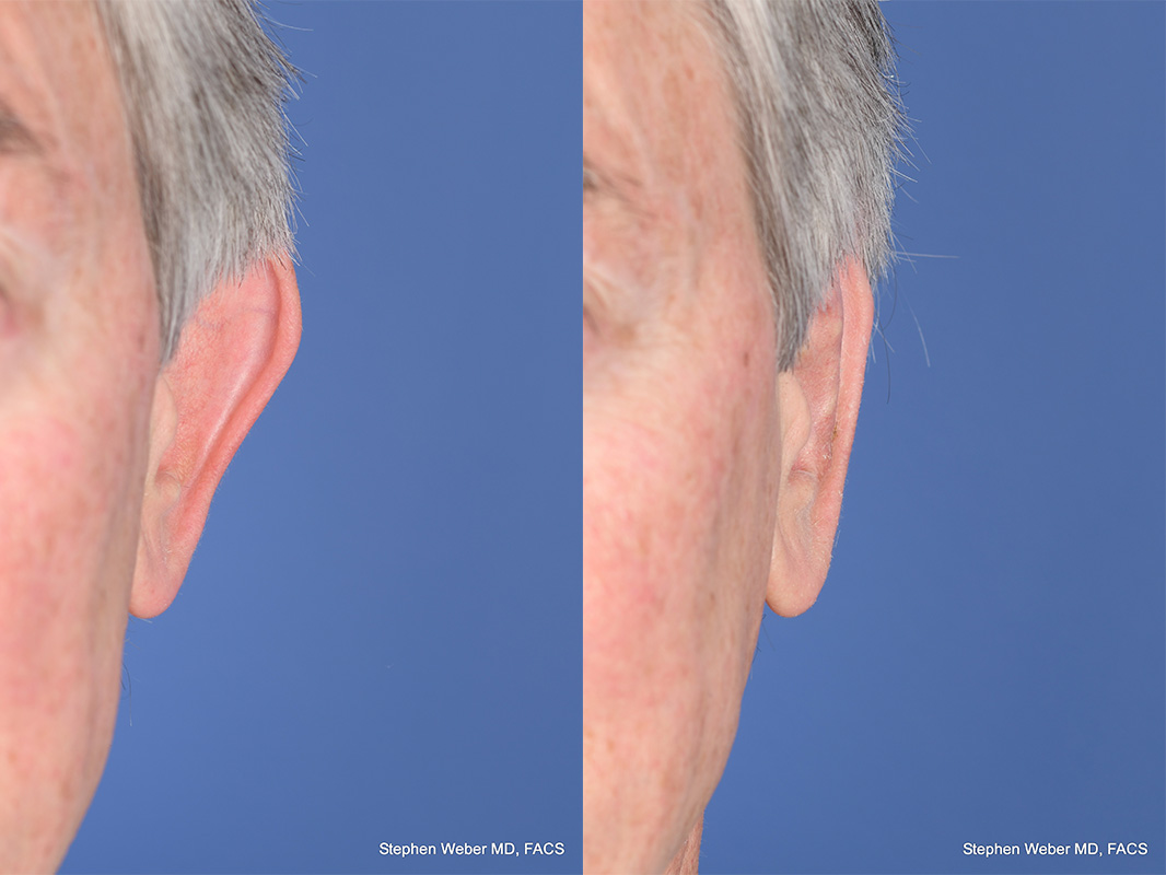 Otoplasty Before and After | Weber Facial Plastic Surgery