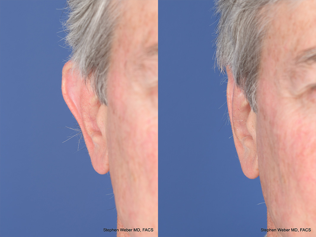 Otoplasty Before and After | Weber Facial Plastic Surgery