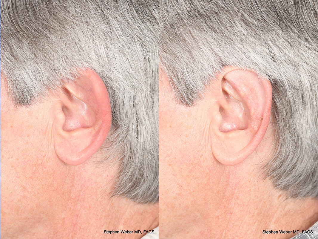 Otoplasty Before and After | Weber Facial Plastic Surgery