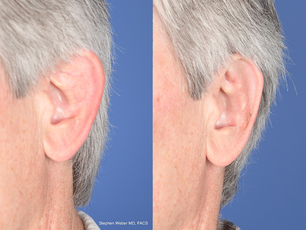 Otoplasty Before and After | Weber Facial Plastic Surgery