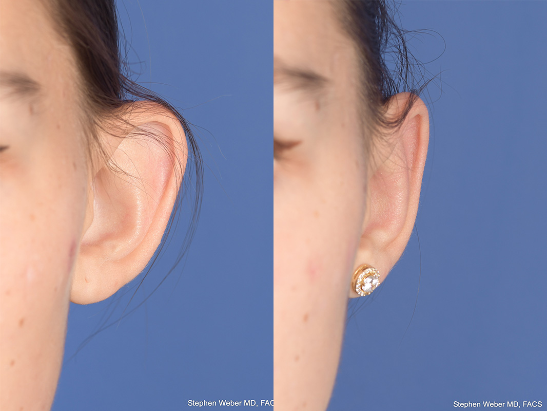Otoplasty Before and After | Weber Facial Plastic Surgery