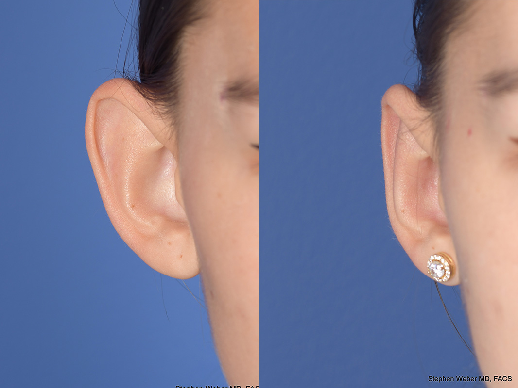 Otoplasty Before and After | Weber Facial Plastic Surgery