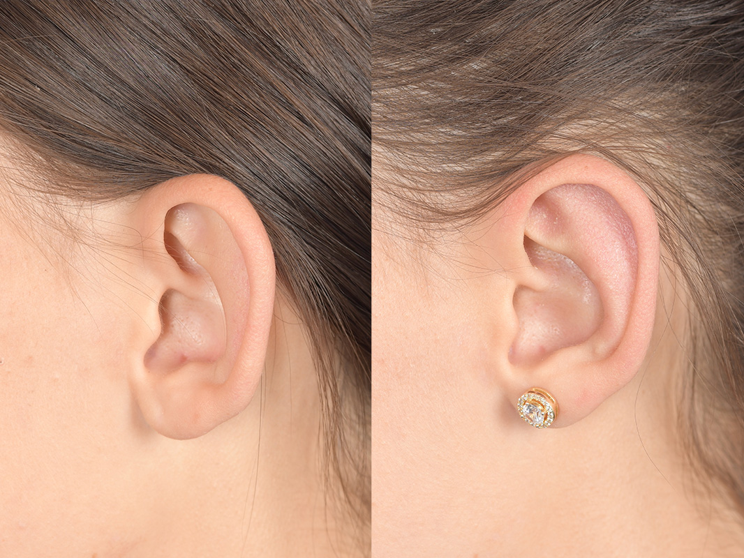 Otoplasty Before and After | Weber Facial Plastic Surgery