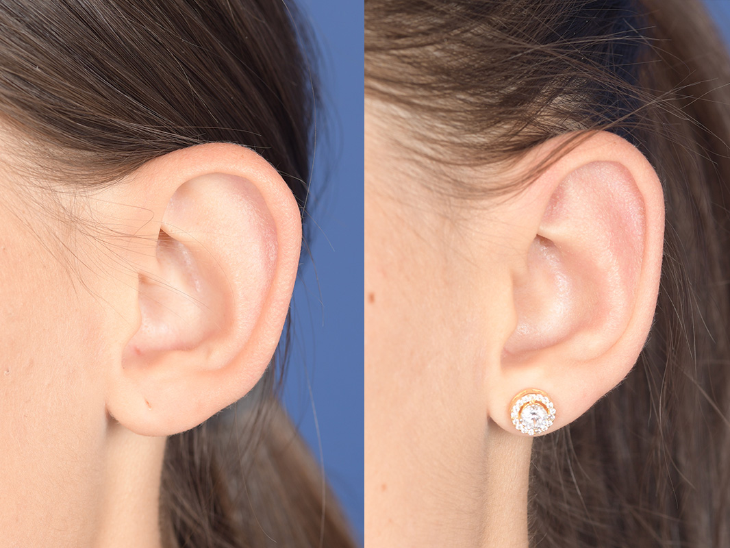 Otoplasty Before and After | Weber Facial Plastic Surgery