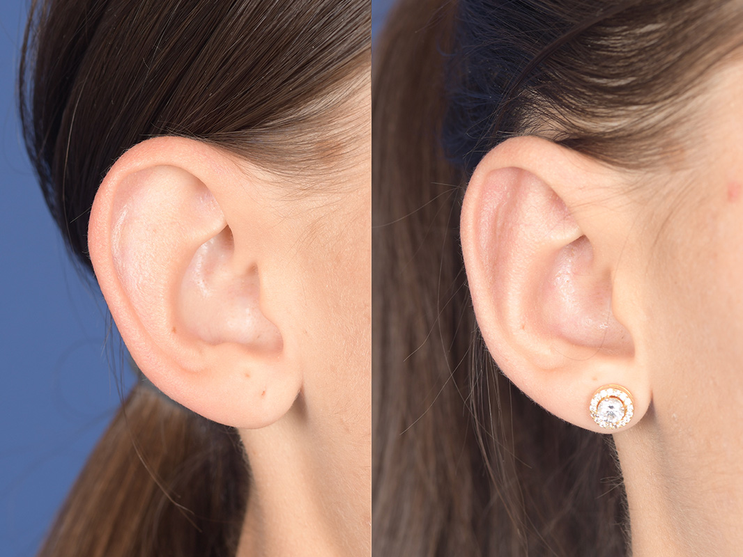 Otoplasty Before and After | Weber Facial Plastic Surgery
