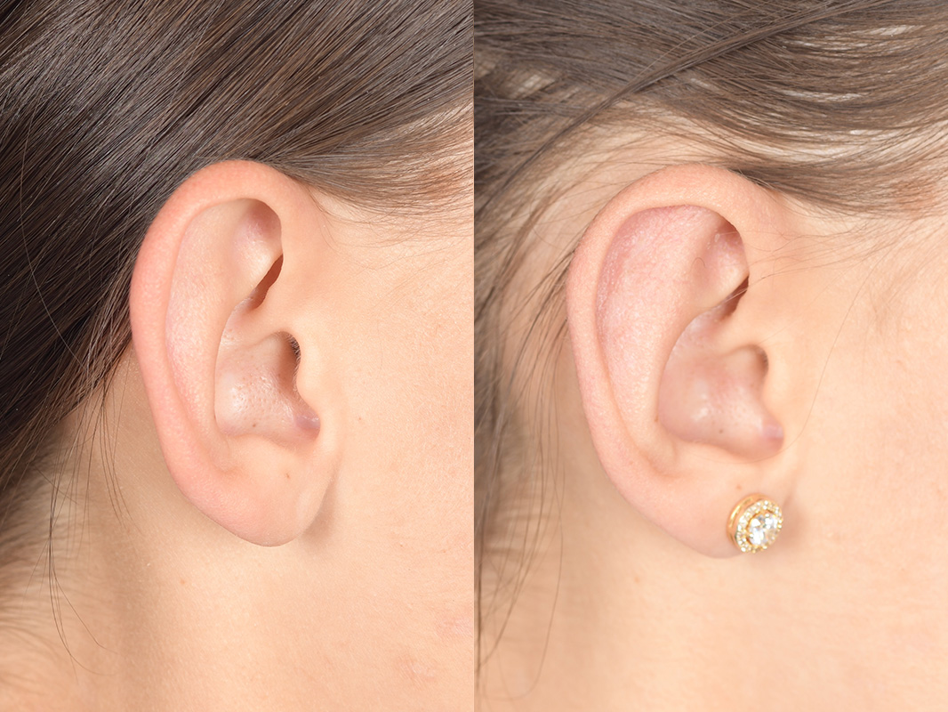 Otoplasty Before and After | Weber Facial Plastic Surgery