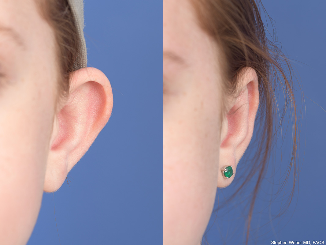 Otoplasty Before and After | Weber Facial Plastic Surgery