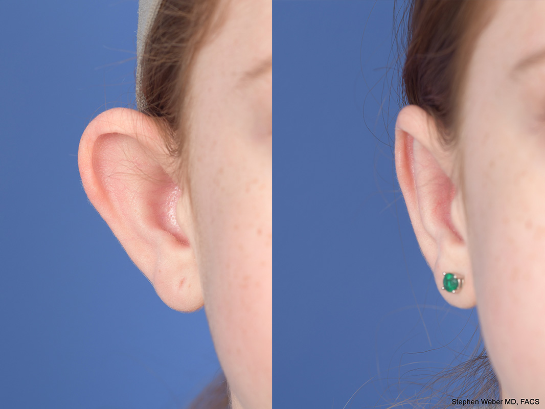 Otoplasty Before and After | Weber Facial Plastic Surgery