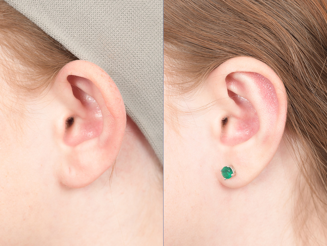 Otoplasty Before and After | Weber Facial Plastic Surgery