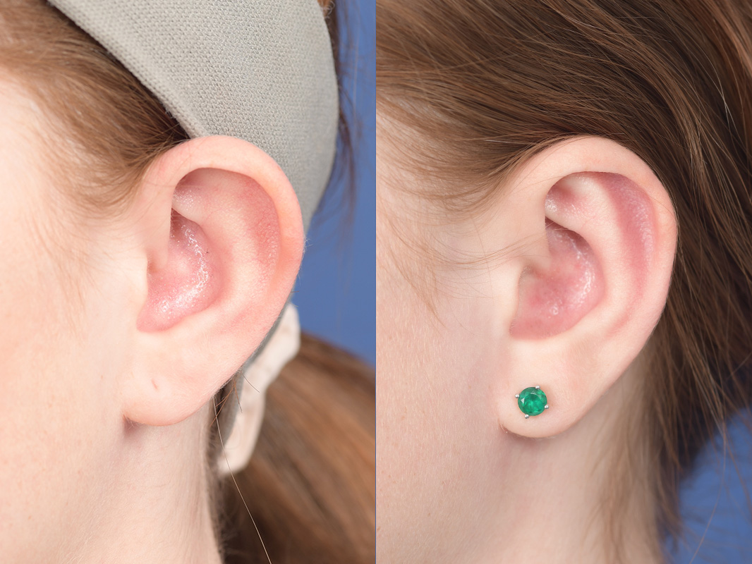Otoplasty Before and After | Weber Facial Plastic Surgery