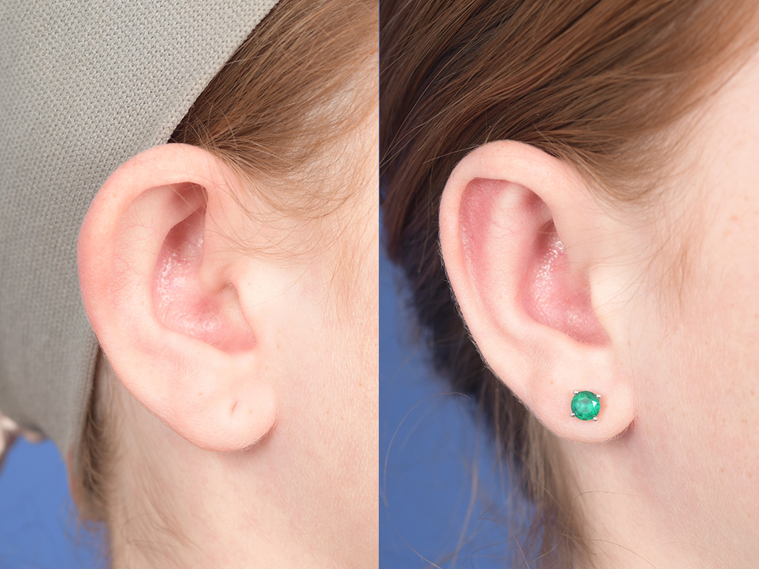 Otoplasty Before and After | Weber Facial Plastic Surgery