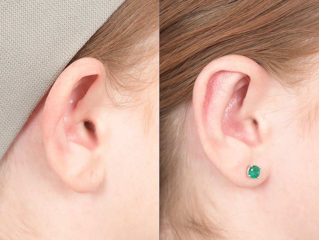 Otoplasty Before and After | Weber Facial Plastic Surgery
