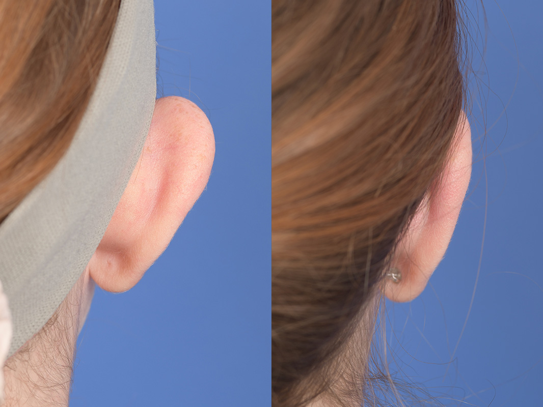 Otoplasty Before and After | Weber Facial Plastic Surgery