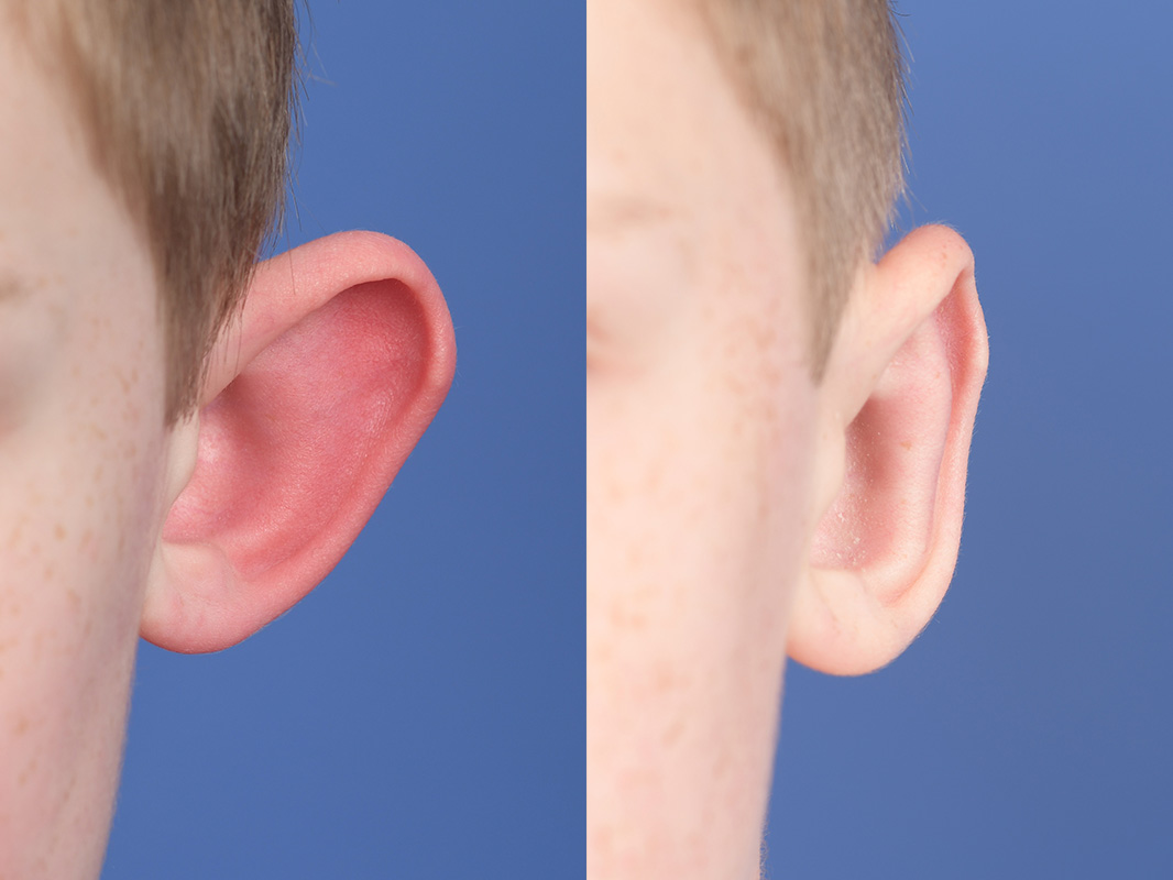 Otoplasty Before and After | Weber Facial Plastic Surgery
