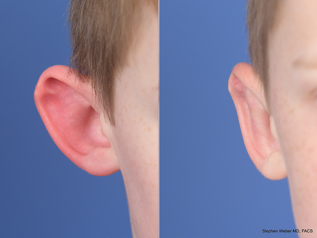 Otoplasty Before and After | Weber Facial Plastic Surgery
