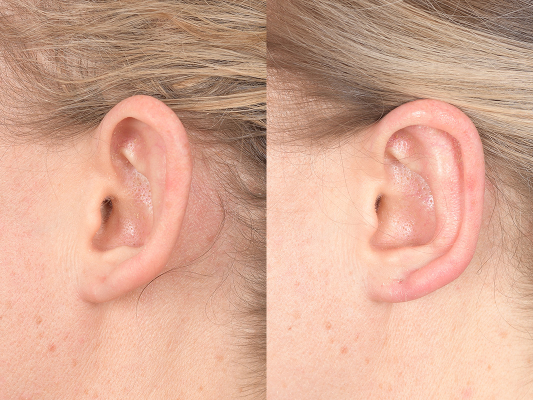 Otoplasty Before and After | Weber Facial Plastic Surgery