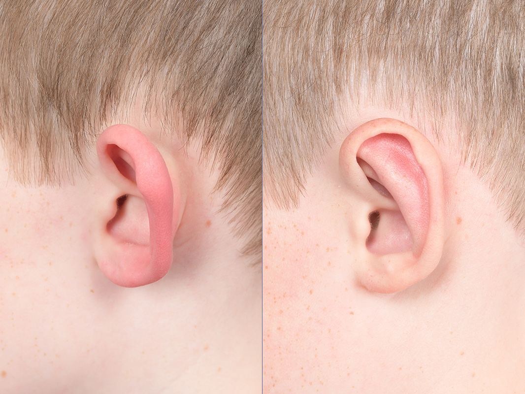 Otoplasty Before and After | Weber Facial Plastic Surgery