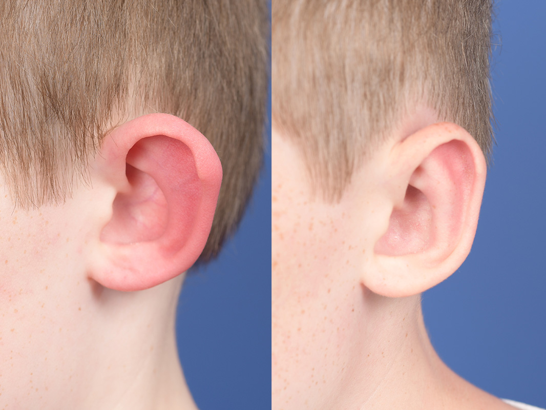 Otoplasty Before and After | Weber Facial Plastic Surgery