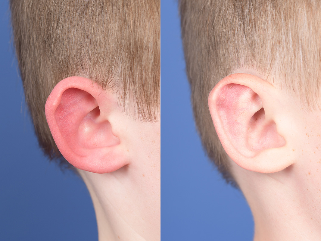 Otoplasty Before and After | Weber Facial Plastic Surgery