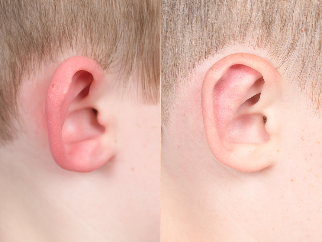 Otoplasty Before and After | Weber Facial Plastic Surgery