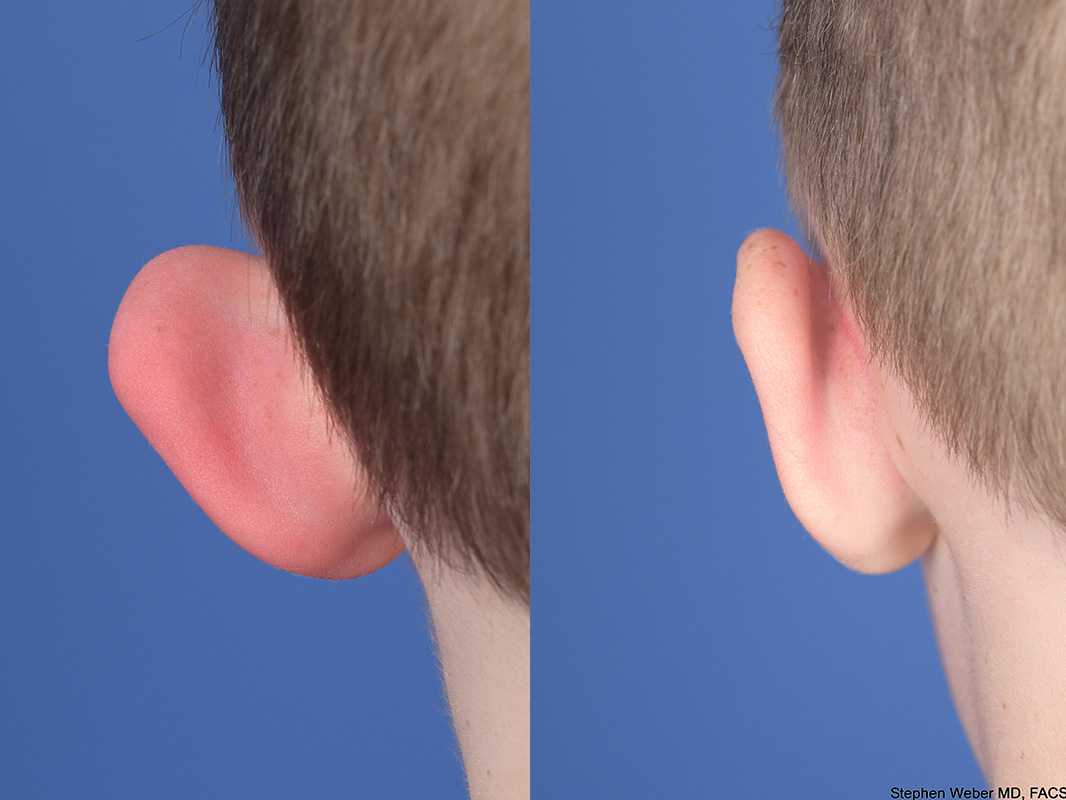 Otoplasty Before and After | Weber Facial Plastic Surgery