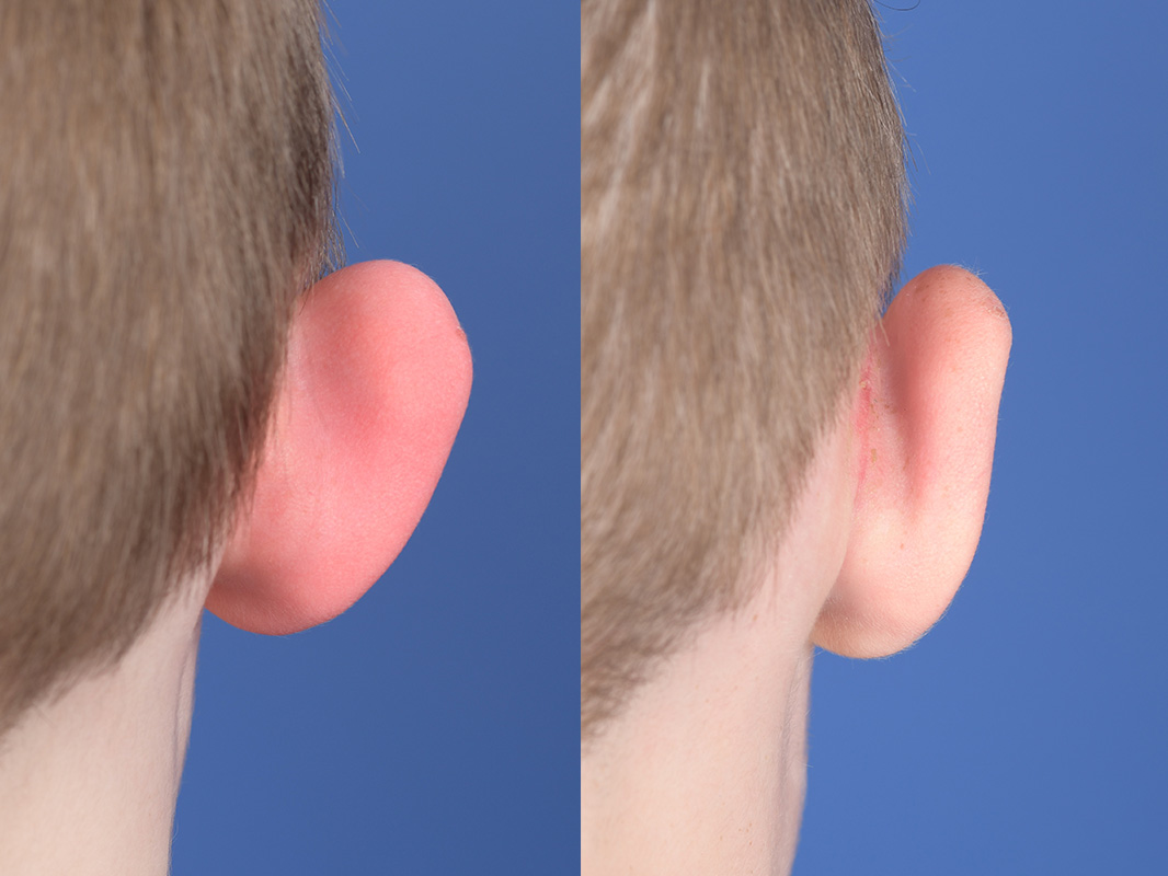 Otoplasty Before and After | Weber Facial Plastic Surgery